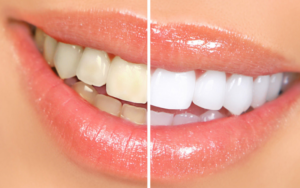 Как убрать изменение цвета на зубах?