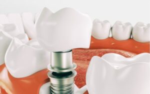 Имплантация зубов All-On-4