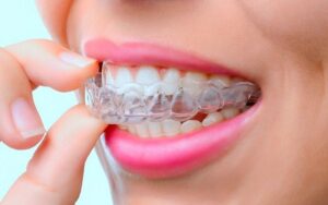 Как выглядят зубы до и после использования элайнеров?