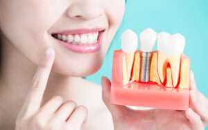 В каких случаях стоит прибегать к протезированию зубов