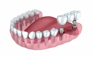 Протезирование зубов: виды протезов и материалы
